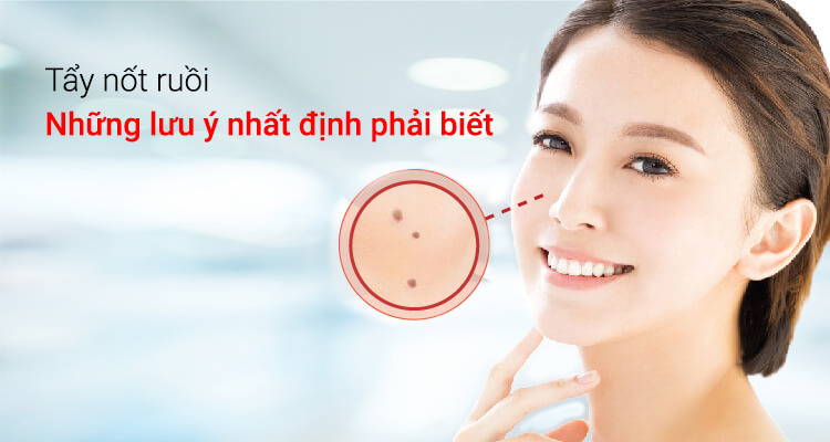Tẩy nốt ruồi - những lưu ý nhất định phải biết