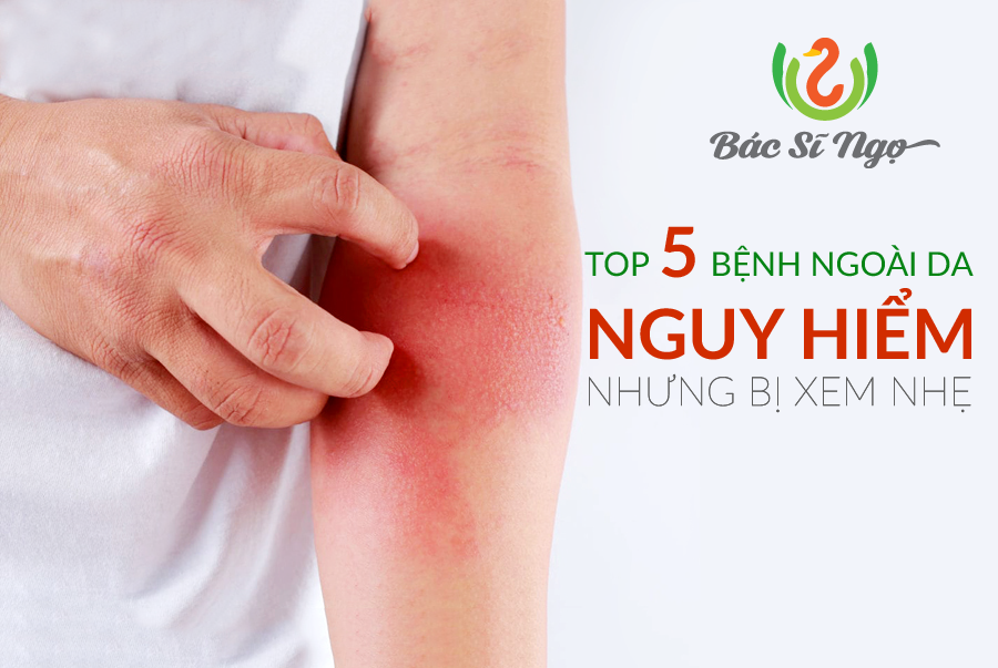 Top 5 bệnh ngoài da nguy hiểm nhưng bị xem nhẹ