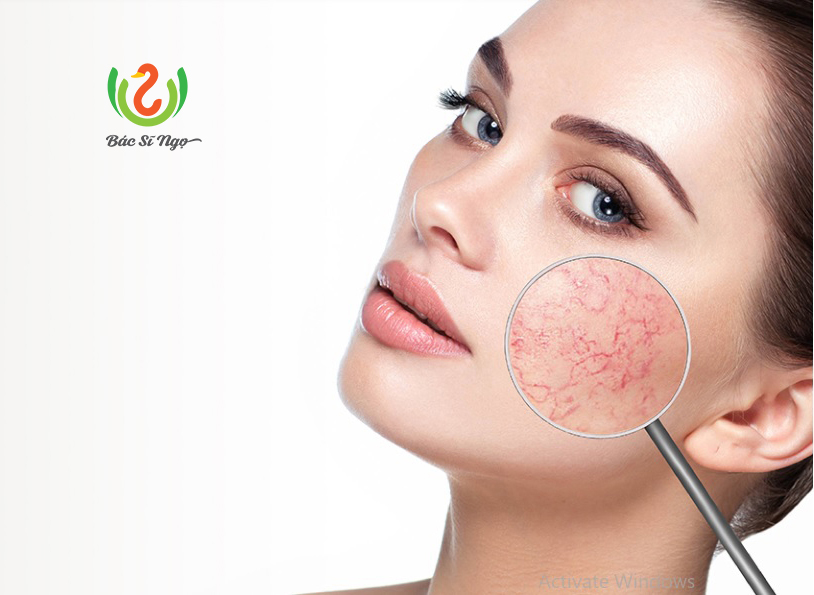 Giãn mao mạch mũi xuất hiện nhiều ở phụ nữ