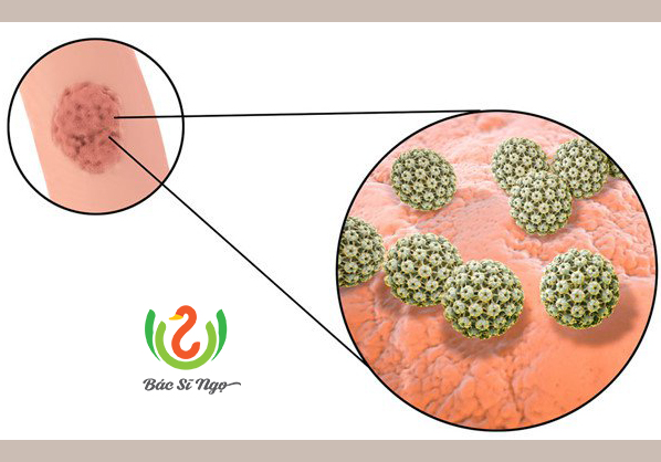 Điều trị bệnh sùi mào gà