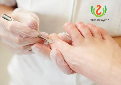 phương pháp điều trị móng chọc thịt