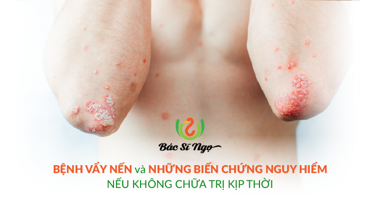 những biến chứng nguy hiểm của bệnh vẩy nến