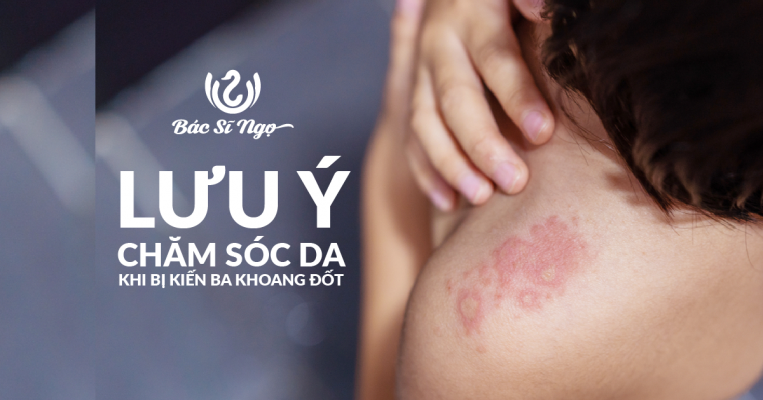 Lưu ý chăm sóc da khi bị kiến ba khoang đốt