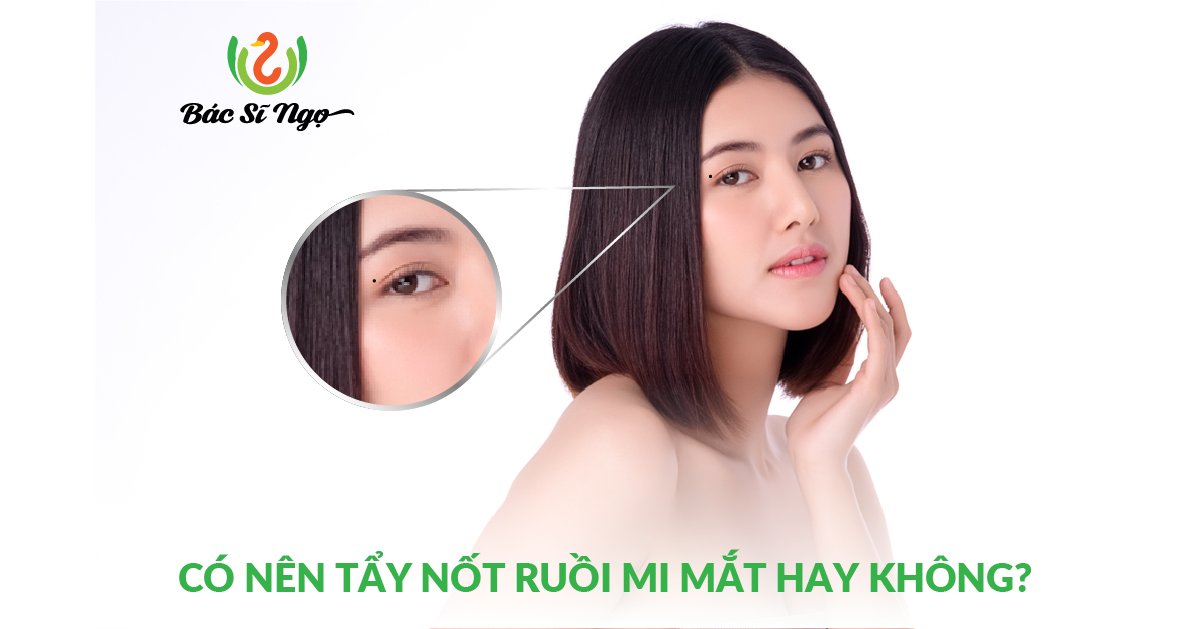 CÓ NÊN TẨY NỐT RUỒI MI MẮT HAY KHÔNG?