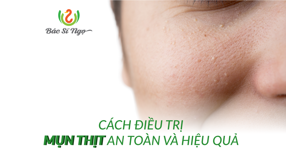 điều trị mụn thịt an toàn và hiệu quả