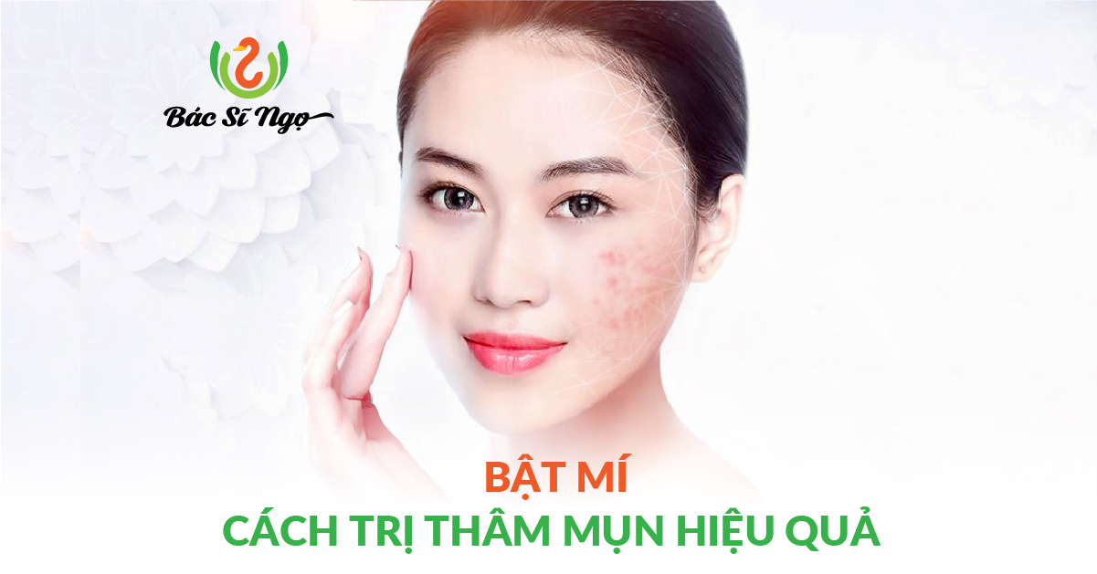 cách trị thâm mụn hiệu quả