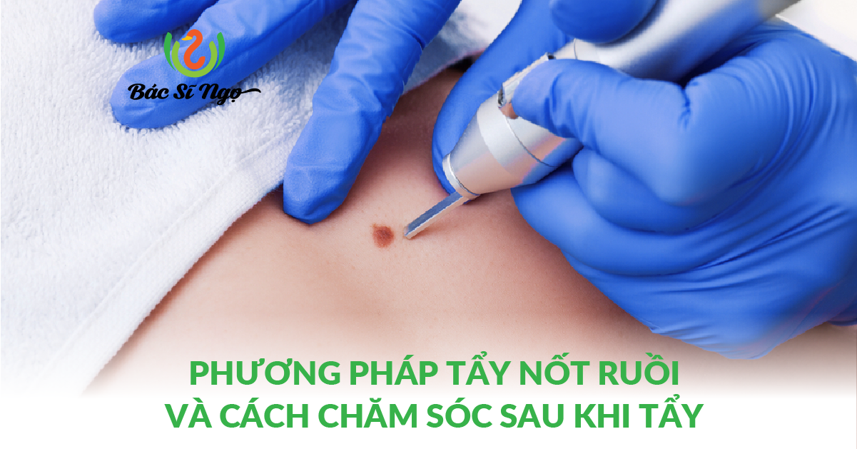 Phương pháp tẩy nốt ruồi và cách chăm sóc
