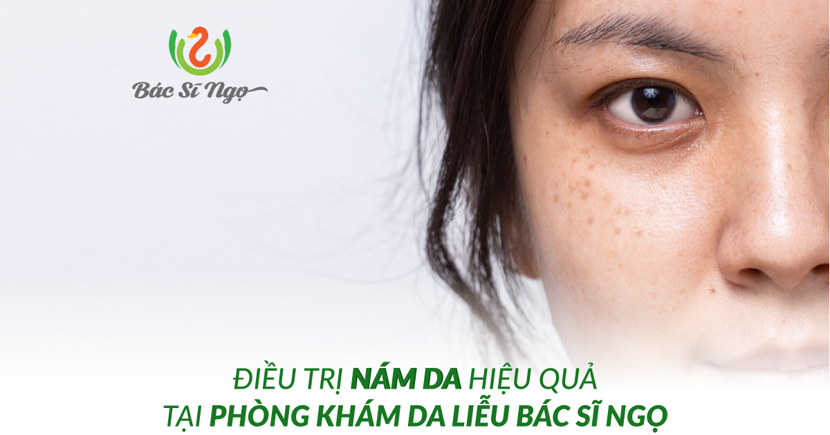 Điều trị nám da hiệu quả