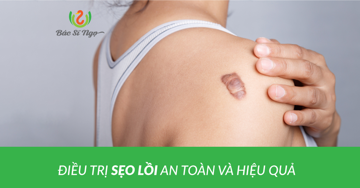 điều trị sẹo lồi an toàn