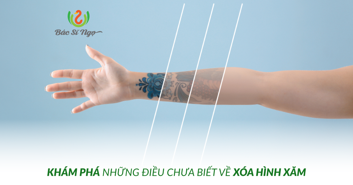 những điều chưa biết về xóa hình xăm