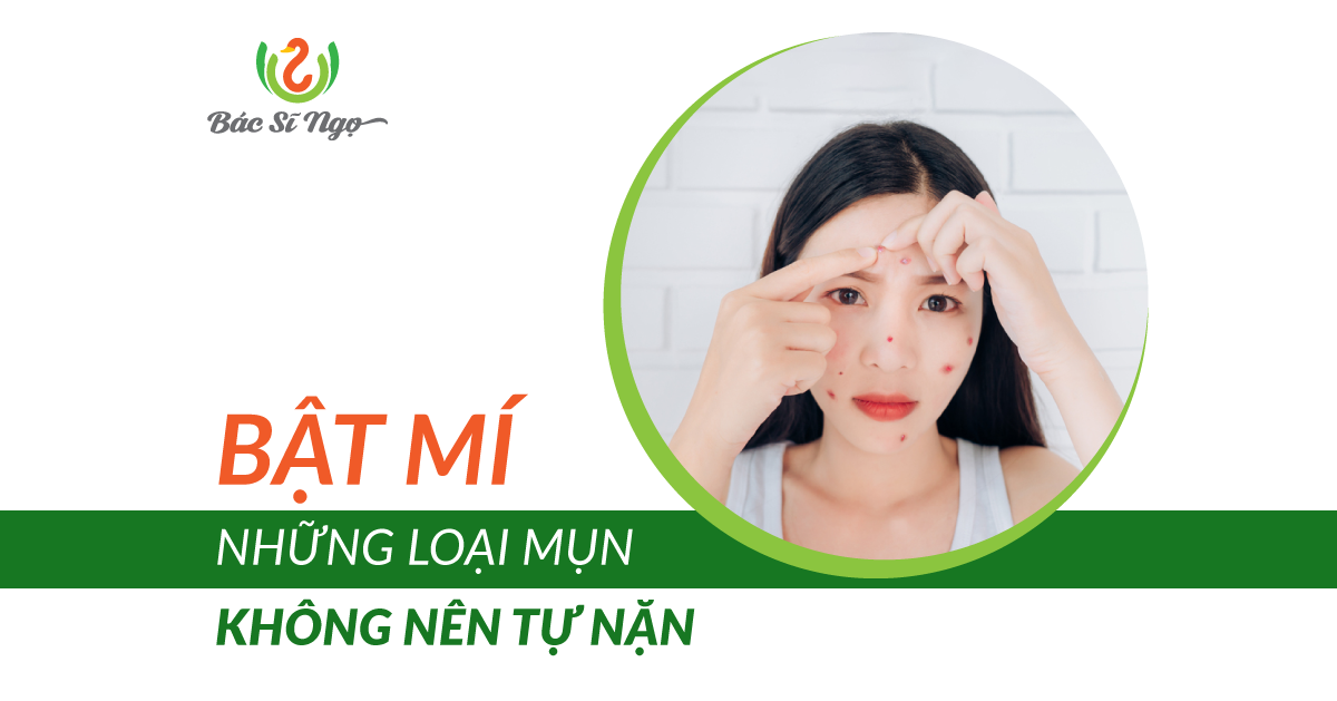 những loại mụn không nên tự nặn